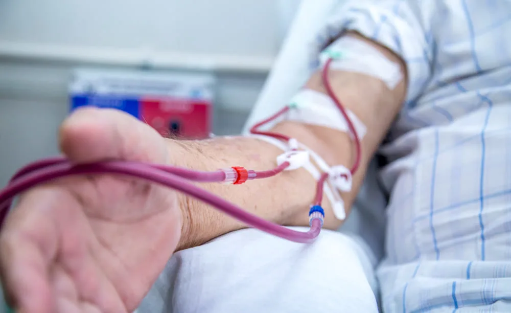 Creación de accesos para hemodiálisis, fístulas arteriovenosas y catéteres de hemodiálisis en Querétaro: Procedimientos esenciales para un tratamiento renal seguro