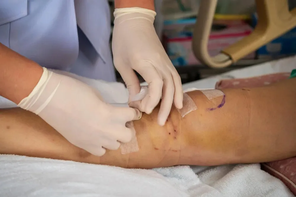 Manejo avanzado de úlceras varicosas en Querétaro: Tratamiento integral para favorecer la cicatrización y prevenir complicaciones