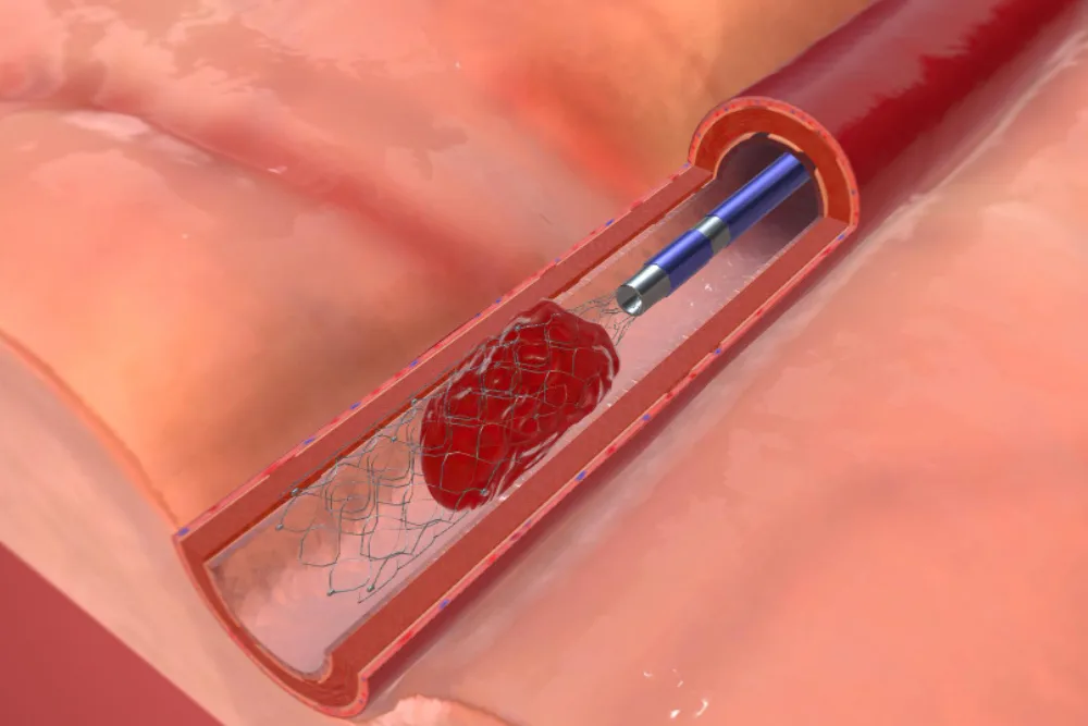 Trombectomía endovascular en trombosis arterial y venosa en Querétaro: Tratamiento mínimamente invasivo para restaurar la circulación