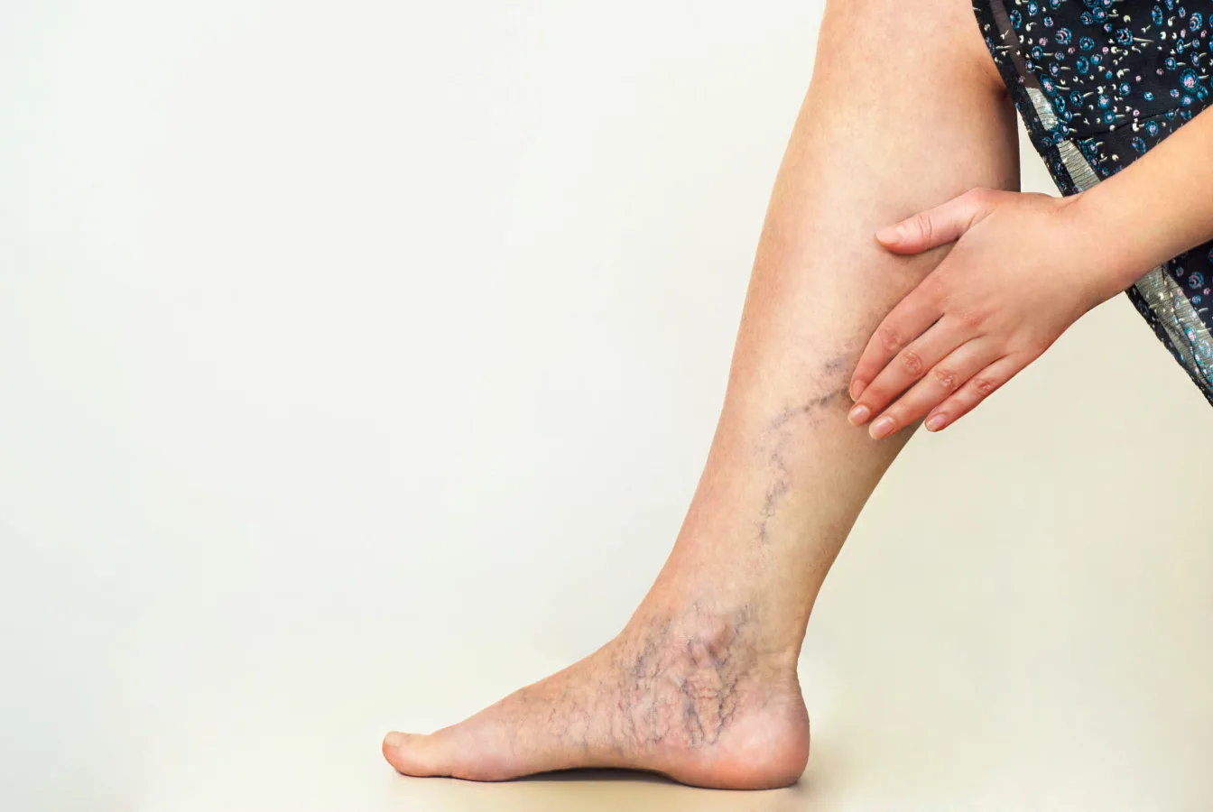 Angiologo para Varices en Hombres en Querétaro