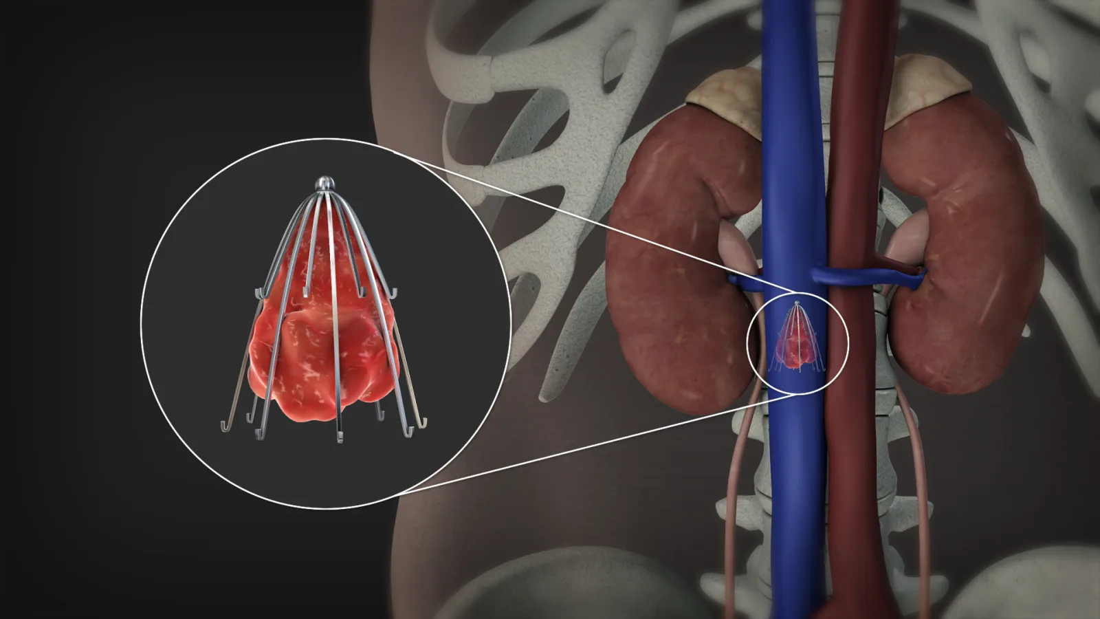 ¿Qué es la embolia arterial y cómo se trata en Querétaro?