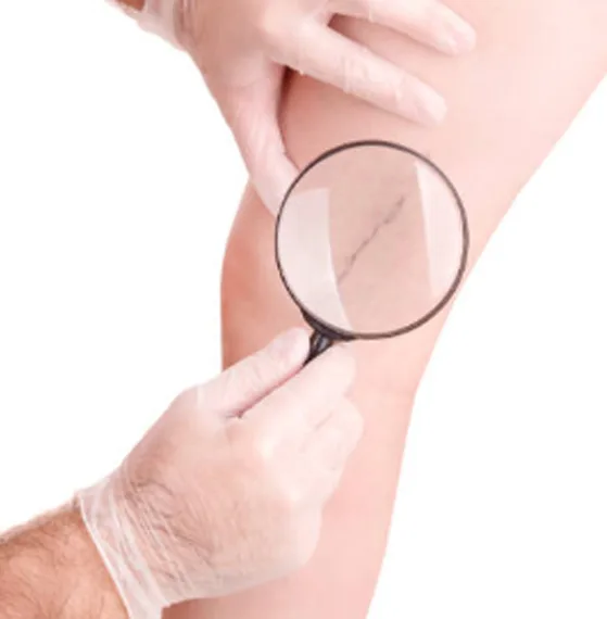 Precio de escleroterapia en Querétaro