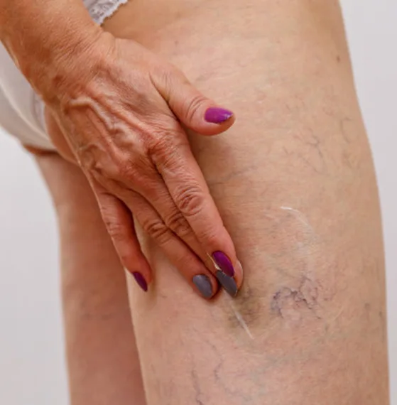 Precio estudio vascular en Querétaro