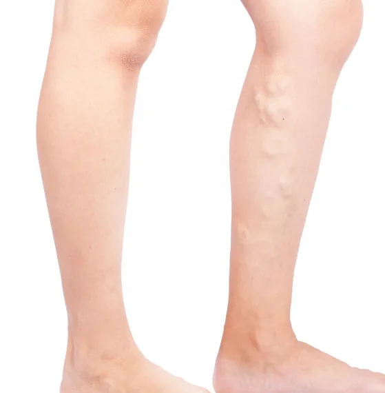 Rehabilitación vascular en Querétaro