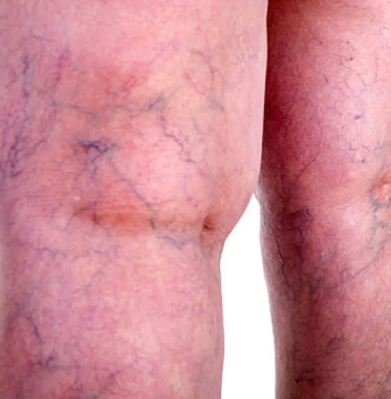 Consulta para tratamiento de Rehabilitación vascular