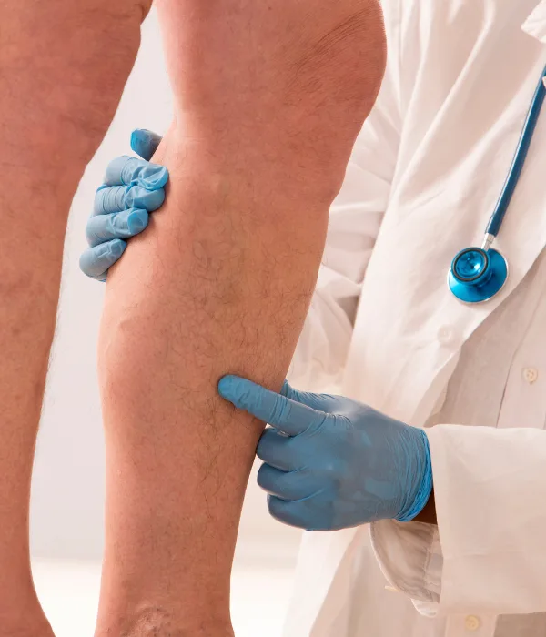 Consulta para Tratamiento médico de insuficiencia venosa