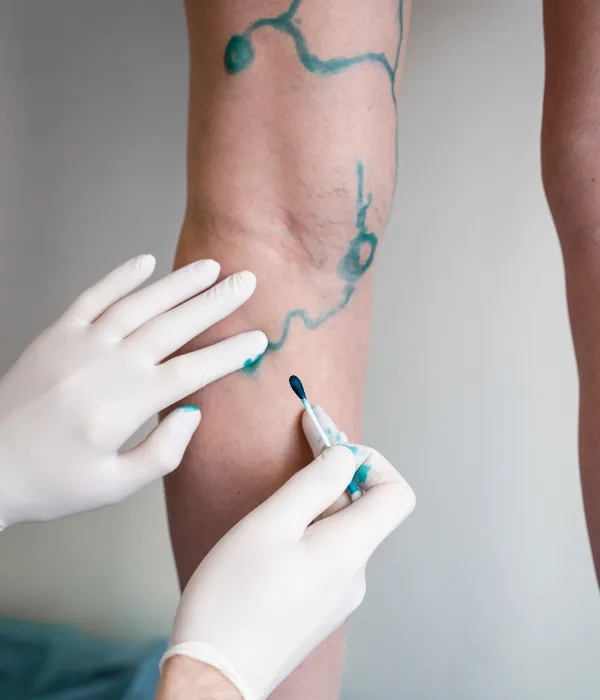 ¿Qué médico trata tromboflebitis?