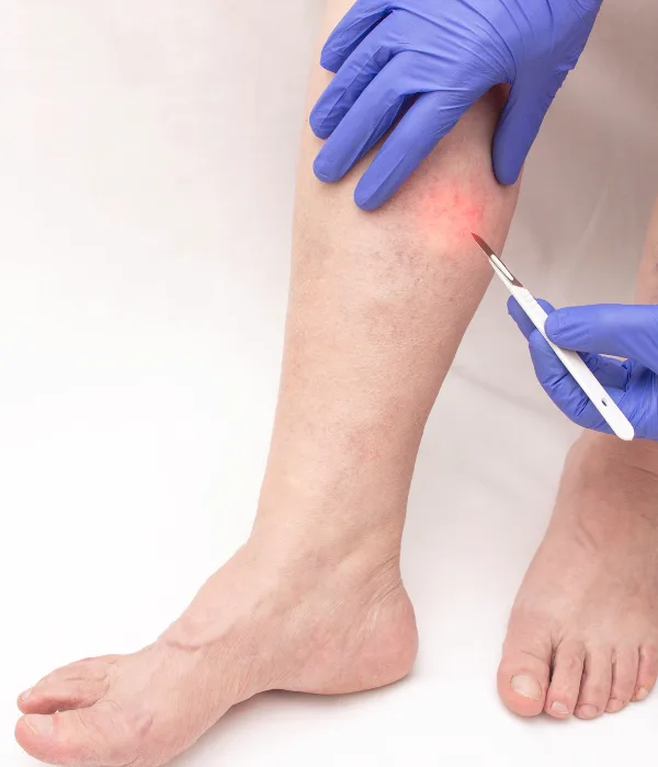 ¿Qué médico trata úlceras venosas?