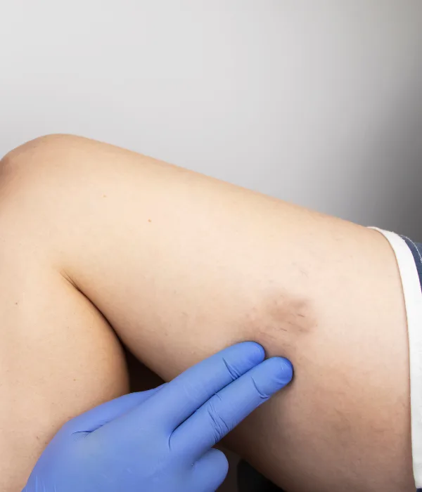 ¿Qué médico trata varices?
