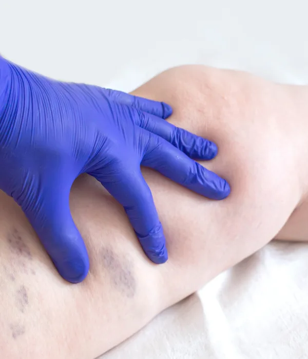 Venas inflamadas o dolorosas en Querétaro